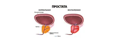 Простатит у мужчин: признаки простатита, острый и хронический простатит