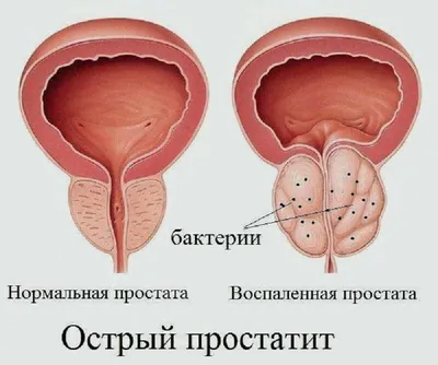 Простатит