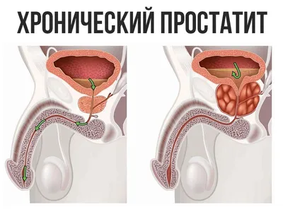 Простатит у мужчин: признаки, симптомы и лечение воспаления предстательной  железы