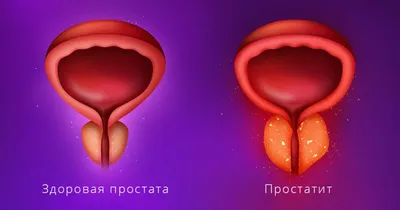 Простатит: симптомы и профилактика