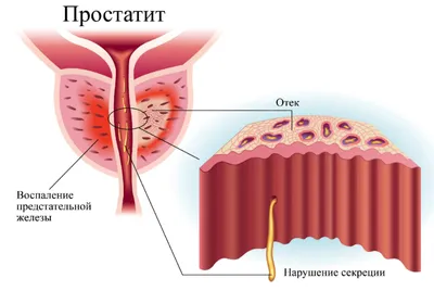 Хронический простатит: виды, причины, диагностика, лечение