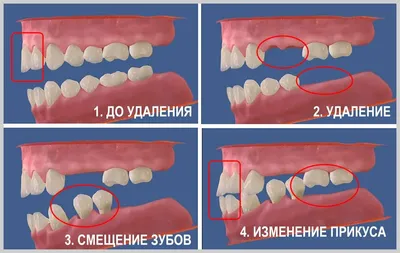 Боль после удаления зуба | Стоматология Митино