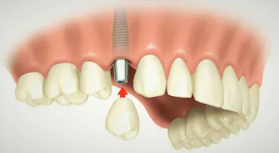 Когда можно проводить имплантацию после удаления зуба? Сроки и особенности  протоколов