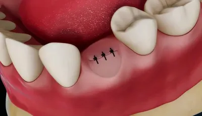 Киста зуба и имплантация - Cтоматология Май