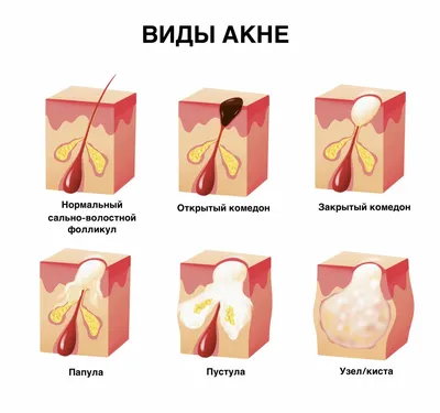 Прыщи на лице (акне) - причины появления, диагностика, лечение и  профилактика