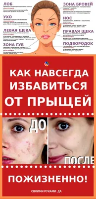 Акне - что это такое, причины возникновения, механизм развития,  классификация, лечение