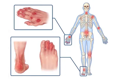 Псориатический артрит - диагностика и лечение по доступным ценам в  Челябинске