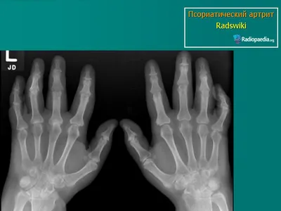 КСС. Псориатический артрит. + | Портал радиологов