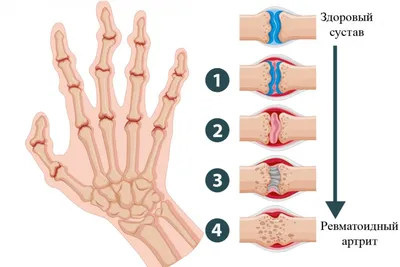 Ревматоидный артрит рук: лечение и симптомы - статьи от компании Еламед