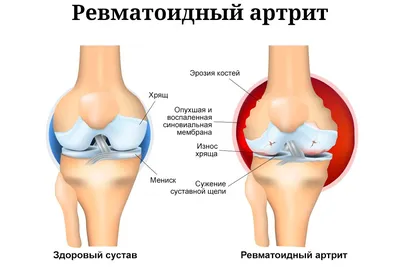 Ревматоидный артрит