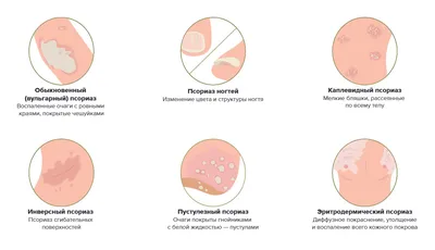 Лечение псориаз кожи в медцентре \"Т-Медикус\" Алматы | Медицинский центр  \"Т-Медикус\"