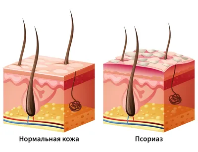 Псориаз - причины, симптомы, диагностика и лечение в Москве