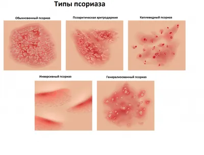 Псориаз и армия: берут ли на службу с таким диагнозом | ВКонтакте