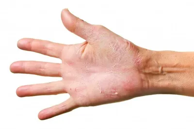 Псориаз на руках: симптомы, лечение, причины возникновения