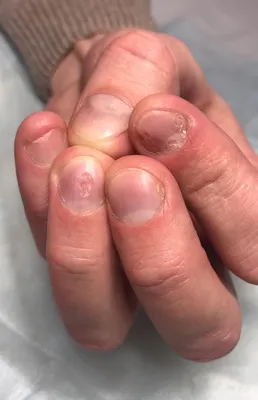 Псориаз на ногтевых пластинах | На ногтях пальцев рук