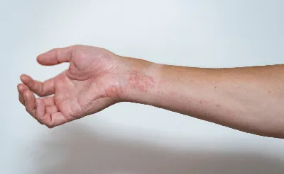 Трещины, шелушение кожи на руках. дерматологические проблемы псориаза. |  Премиум Фото