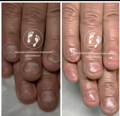 Псориаз ногтей: признаки и методы лечения | Статьи «Омнифарм»