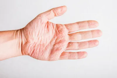 Псориаз ногтей — это особая форма псориаза, при которой поражаются ногти на  руках и/или ногах. Врачи называют этот вид болезни… | Instagram