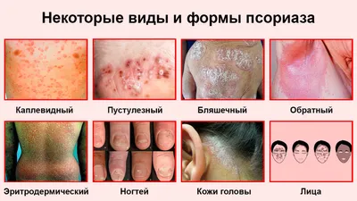 Диагност Малиновская назвала болезни, с которыми часто путают псориаз |  DOCTORPITER