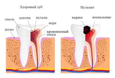 Пульпит: острый и хронический. Лечение пульпита в Санкт-Петербурге