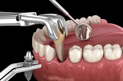 Пульпит зуба лечение - Endostom