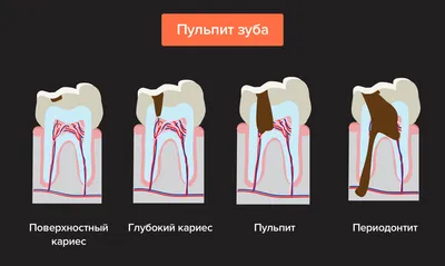 Симптоматический пульпит – лечение зуба с микроскопом