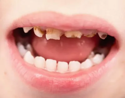 Пульпит зуба у взрослых — симптомы, причины, лечение и виды