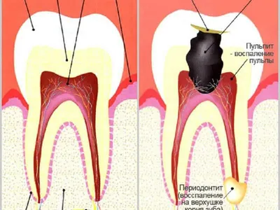 Лечение пульпита и периодонтита в стоматологии Эстетика Волгоград