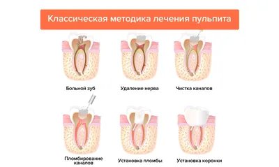 Лечение пульпита - виды, причины, диагностика