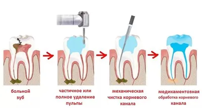 Пульпит зуба — этапы и методы лечения | «Дента-Профессионал»