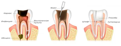 Пульпит (зуба): симптомы, лечение в Иркутске в Клинике Эксперт