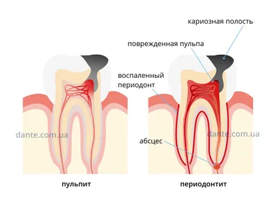 Пульпит - Стоматологическая клиника Дентсервис