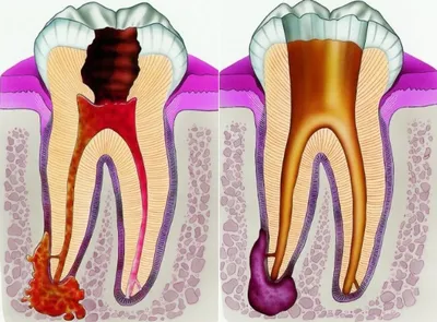 Пульпит: причины, формы и профилактика заболевания | D.Ante