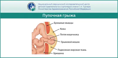 Пупочная грыжа. Если кто ещё не решился на харакири | Пикабу