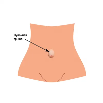 Пупочная и срединная грыжа - Александр Смоляр