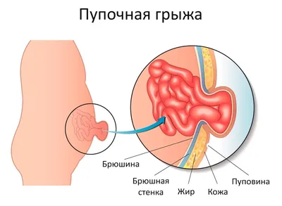 Пупочная грыжа