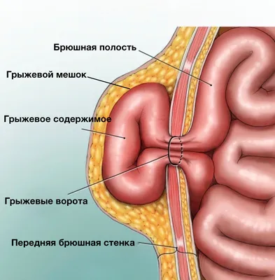 Пупочная грыжа: симптомы, профилактика, лечение — Секрет фирмы