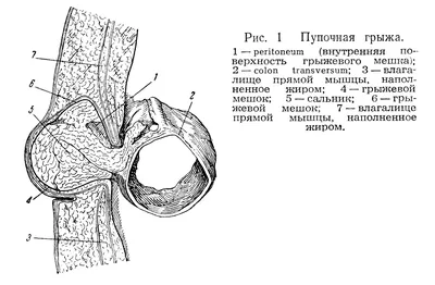 🏥 ✓Лечение пупочной грыжи ⋆ 2023