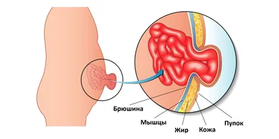 Пупочная грыжа