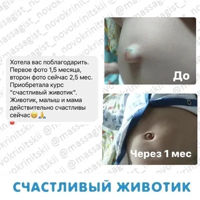 Пупочная грыжа у новорожденного... - Массажный кабинет | Facebook