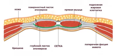 Амбулаторное лечение пупочной и паховой грыжи | Частная клиника в Челябинске