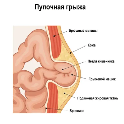 Пластический хирург Малкаров Марат - 📌Пупочная грыжа является частым  послеродовым осложнением. Специалисты отмечают, что это осложнение чаще  возникает у женщин, у которых во время беременности был большой живот или  роды были проведены