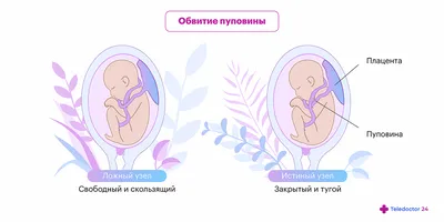 Обвитие пуповиной при беременности — причины, диагностика и риски.