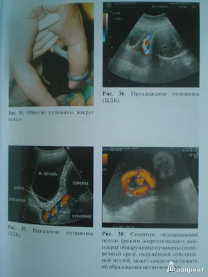 Все о пуповине в родах - Иркутский городской перинатальный центр имени  Малиновского М.С.