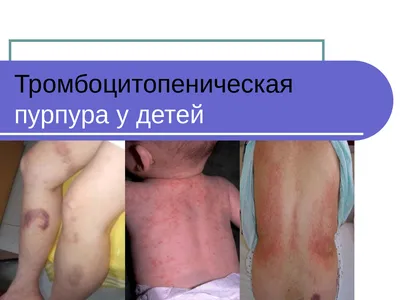 Пурпура - Консультация Дерматолога Онлайн iDerma