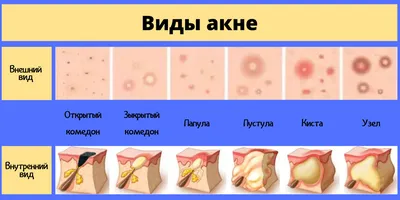 Клинический опыт применения топического изотретиноина в лечении акне  папуло-пустулезной формы