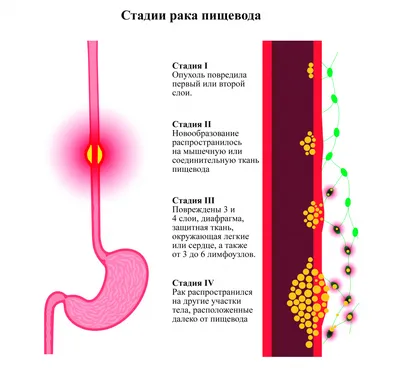 Холангиокарцинома — Википедия