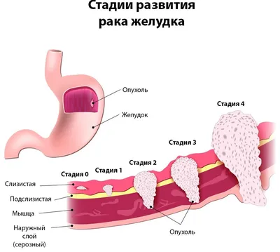 Как лечить рак на 4 стадии?