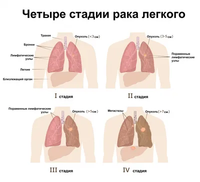 Метастазы колоректального рака в печень