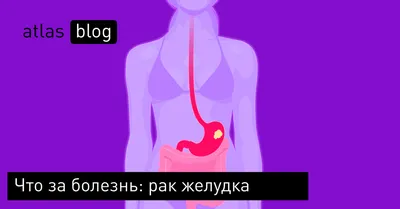 Почему злокачественную опухоль называют раком? — Музей фактов